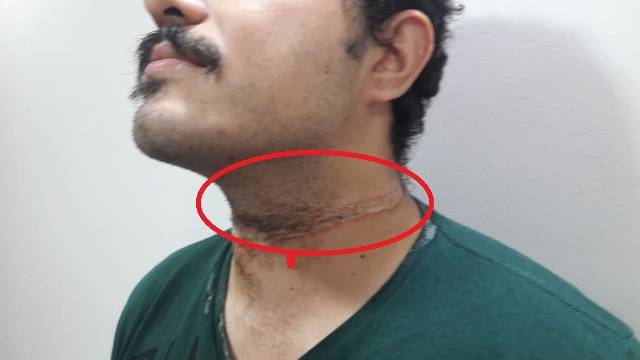 POR UM TRIS: Caminhão da prefeitura atinge fiação e rapaz de 24 anos quase é degolado em Vilhena