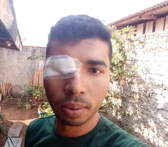 Após ter olho removido em cirurgia, vilhenense de 21 anos pede ajuda para implantar prótese; saiba como colaborar