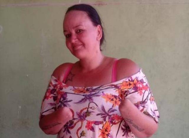Internautas se mobilizam e mulher que teve mãos amputadas pelo marido em cidade da região vai ganhar próteses