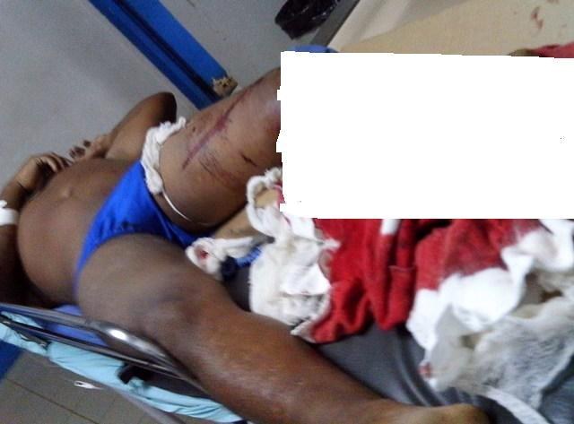 Após acidente, motoqueiro está em coma e caroneiro tem perna decepada