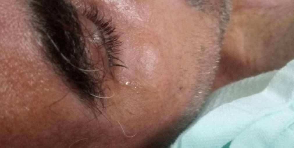 Internado há seis meses e implorando por cirurgia, morador de Colorado do Oeste está ficando com o corpo “em carne viva”