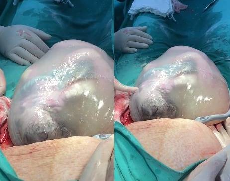 VÍDEO EMOCIONANTE: parto raro de gêmeos prematuros é realizado em Vilhena e comove equipe médica