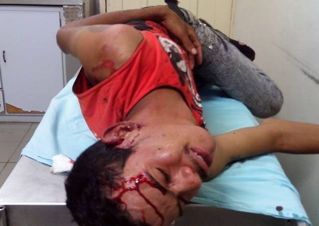 Jovem quase perde a orelha durante roubo de bicicleta