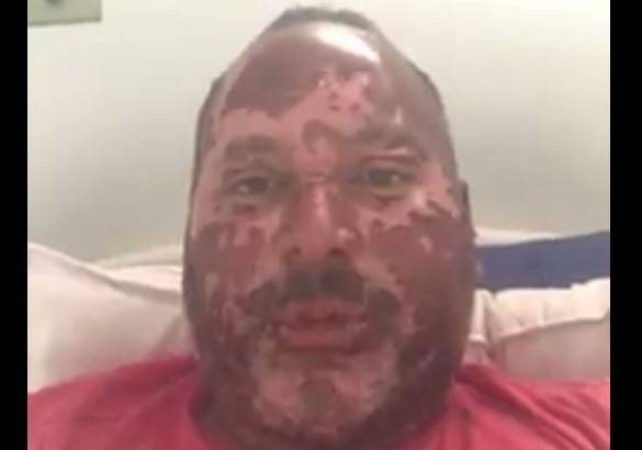ASSISTA: com queimaduras após explosão de forno, advogado de Cerejeiras publica vídeo de agradecimento nas redes sociais