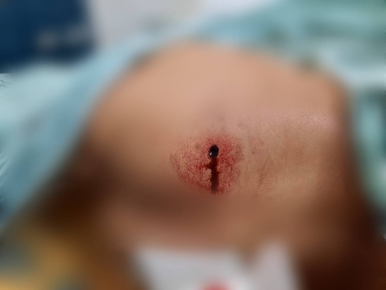 Foragido da Colônia Penal de Vilhena é atingido com tiro nas nádegas; apenado de 22 anos foi socorrido por Bombeiros