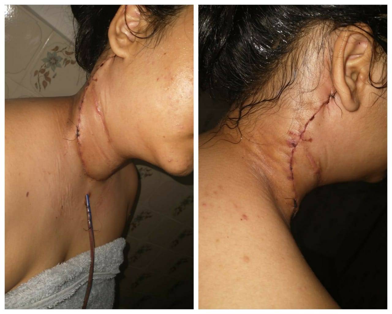 Adolescente de Cerejeiras que extraiu 28 nódulos após câncer no pescoço vende rifas e pede ajuda para tratamento