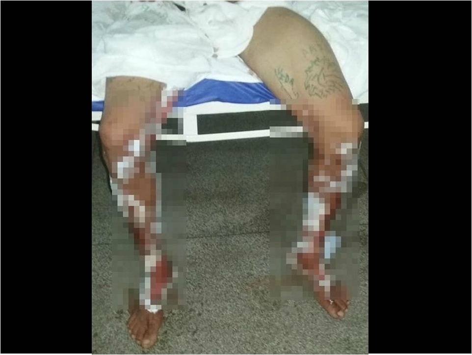Por dívida de drogas, traficantes jogam gasolina e ateiam fogo em “cliente” de 29 anos em Cerejeiras
