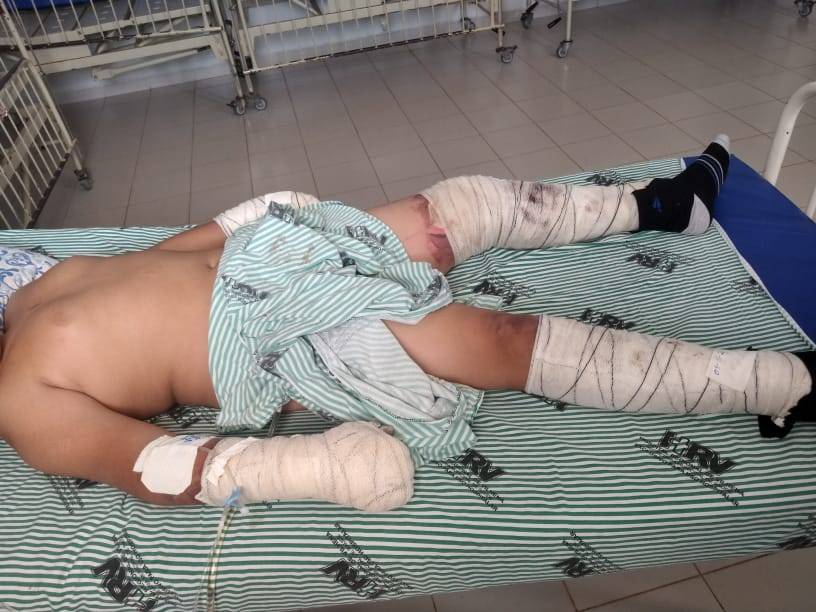 Garoto de 12 anos sofre queimaduras graves ao tentar pegar pipa em terreno baldio; homem que estava no local evitou morte