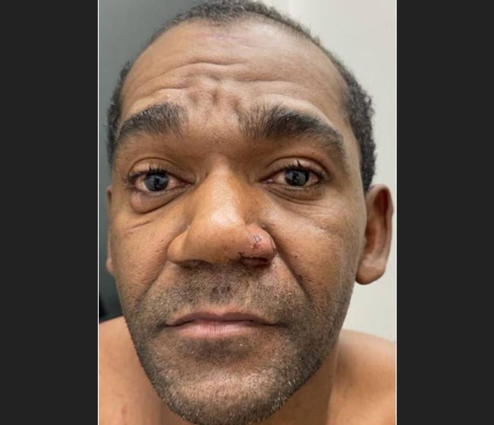 Homem que espancou mulher com problemas psiquiátricos em Vilhena está foragido; vítima das agressões segue internada