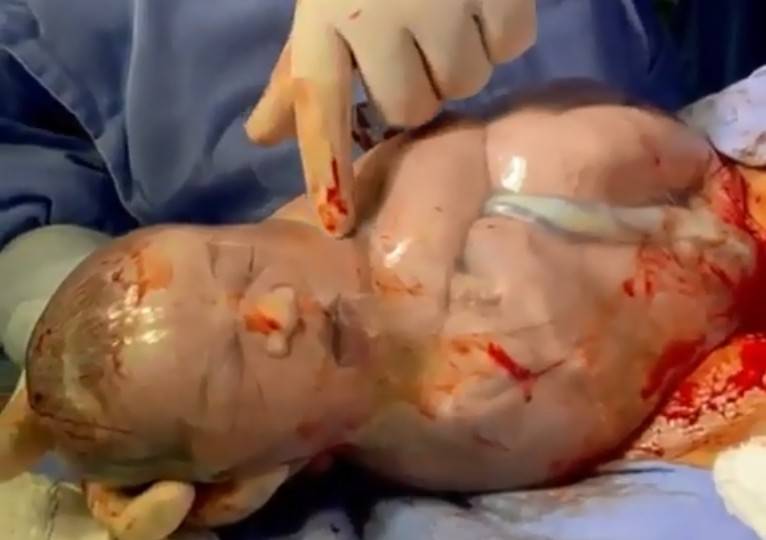 ASSISTA E SE EMOCIONE: garota de 18 anos dá à luz “bebê empelicado” em Vilhena e vídeo viraliza em todo o país