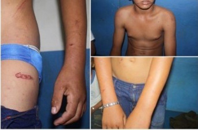 Pai amarra, espanca e queima os próprios filhos de 7 e 13 anos