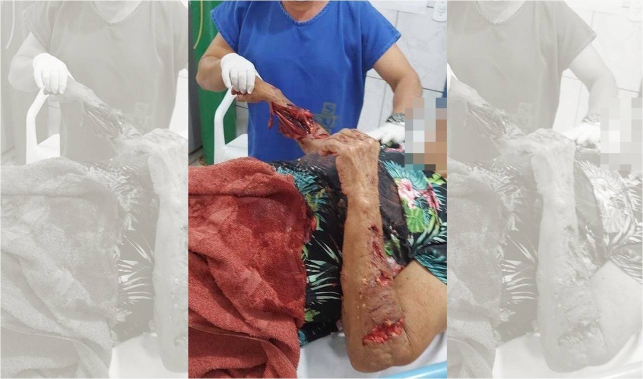Idosa tem braços dilacerados após ataque de pitt bulls em cidade de Rondônia; FOLHA entrevistou neto da vítima