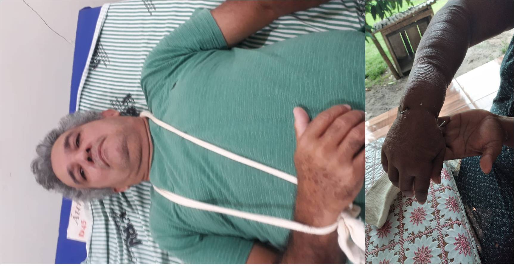 Homem que caiu de moto dentro de rio junto com a esposa na área rural de Chupinguaia precisa de ajuda para custear cirurgia