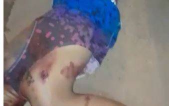 Rapaz baleado ontem em Vilhena foi operado e está intubado em estado gravíssimo na UTI do Hospital Regional