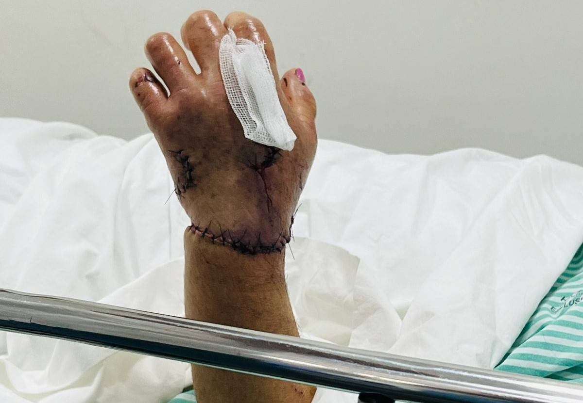 Atacada por anta na área rural de Vilhena, professora de 66 anos corre risco de precisar amputar a mão; filha pede orações