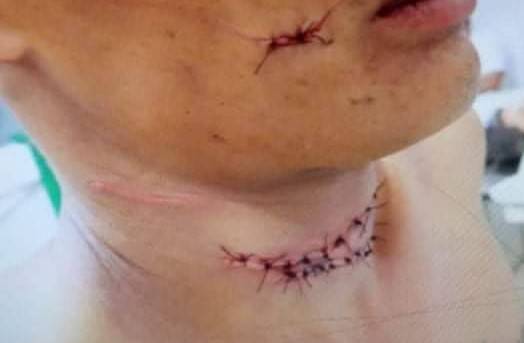 Homem que quase foi degolado e deu nome falso em hospital de Vilhena estava foragido havia dois anos