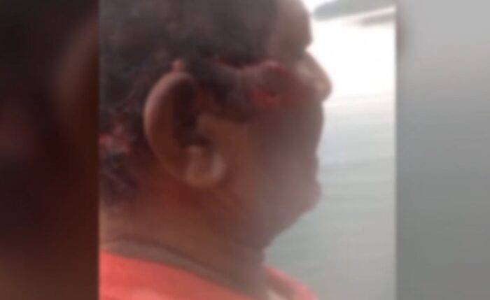 ASSISTA: viraliza em Rondônia vídeo-reportagem sobre ataque de onça pintada contra indígena que ficou mutilado em MT