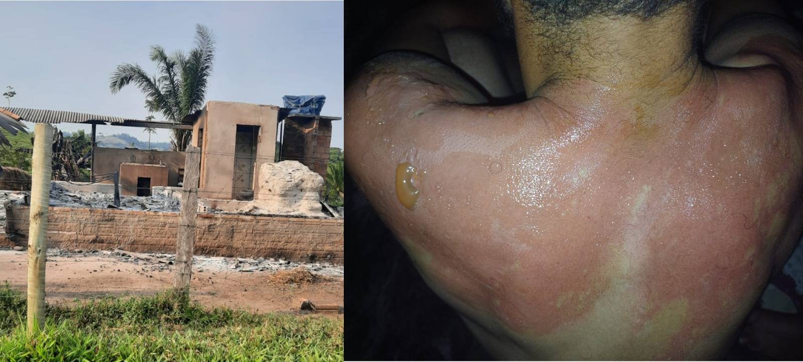 Curto circuito provoca incêndio e destrói casa na zona rural de Corumbiara; sitiante sofre queimaduras combatendo as chamas