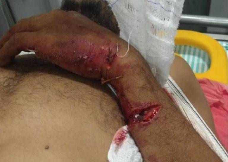 Atacado a facãozadas por casal e comparsa em Vilhena, homem chega a hospital com fratura exposta no braço
