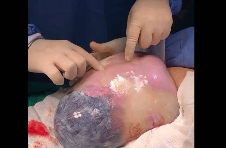 ASSISTA VÍDEO: dentista de 26 anos dá à luz mais um bebê empelicado em hospital público de Vilhena e agradece equipe médica