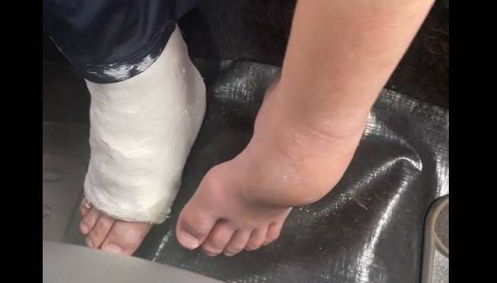 ASSISTA VÍDEO: menino autista de 12 anos tem pé engessado por engano em Vilhena; Santa Casa explica diz que servidor foi advertido