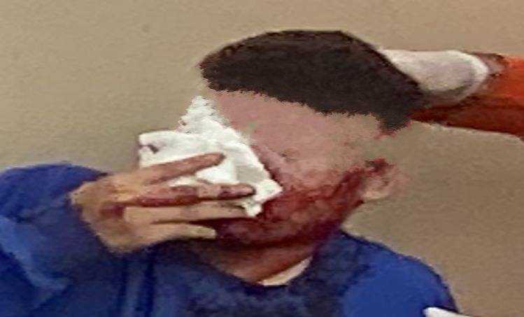 Acusado de matar dependente químico em Vilhena, rapaz de 18 anos é preso logo após sair da UTI e sobreviver a tiro no rosto
