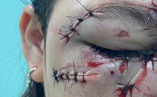 Ao ver namorada dançando, homem enciumado esfaqueia um e acerta garrafada que pode fazer comerciante de Chupinguaia perder a visão
