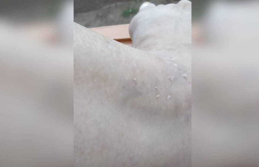 Atacada por cão vira-lata em Vilhena, mulher de 55 anos pede conscientização de tutores e cobra ação das autoridades