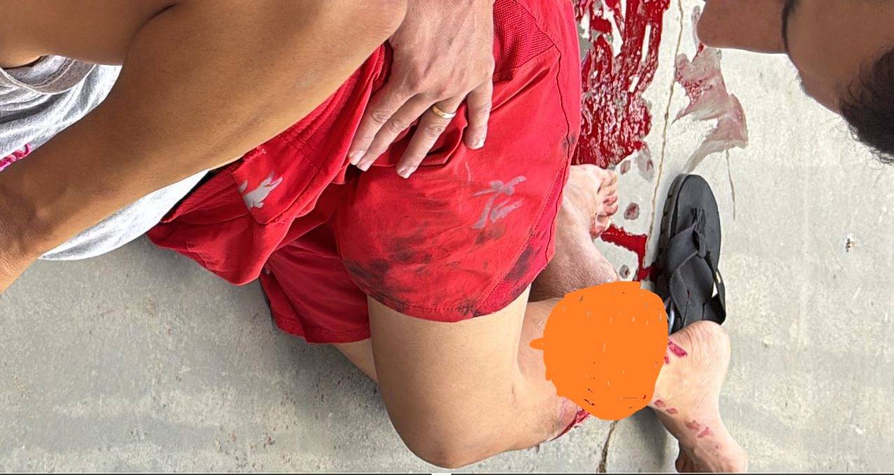 IMAGENS FORTES: acidente envolvendo moto e caminhão no centro de Vilhena deixa mulher com fratura exposta na perna