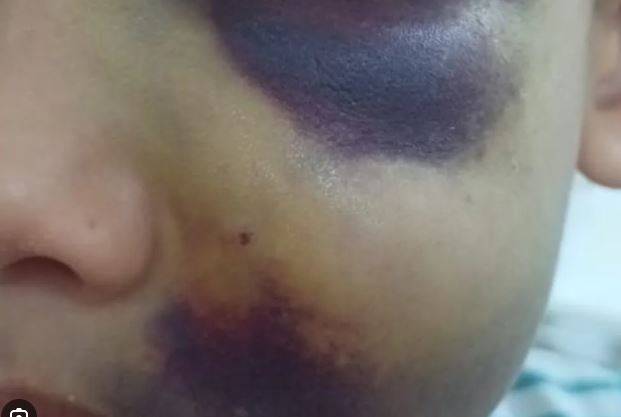 Com hematoma no rosto, menino de apenas 4 anos andando sozinho pela rua, em Vilhena, mobiliza Polícia Militar e Conselho Tutelar