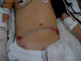 Durante briga de casal em Vilhena, mulher crava faca no corpo do marido, mas garante que golpe foi “acidental”