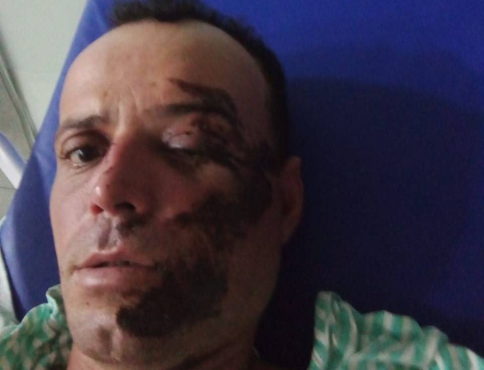 Homem que ficou desmaiado após sofrer queda de moto ao passar por quebra-molas em Vilhena fala ao FOLHA DO SUL ON LINE