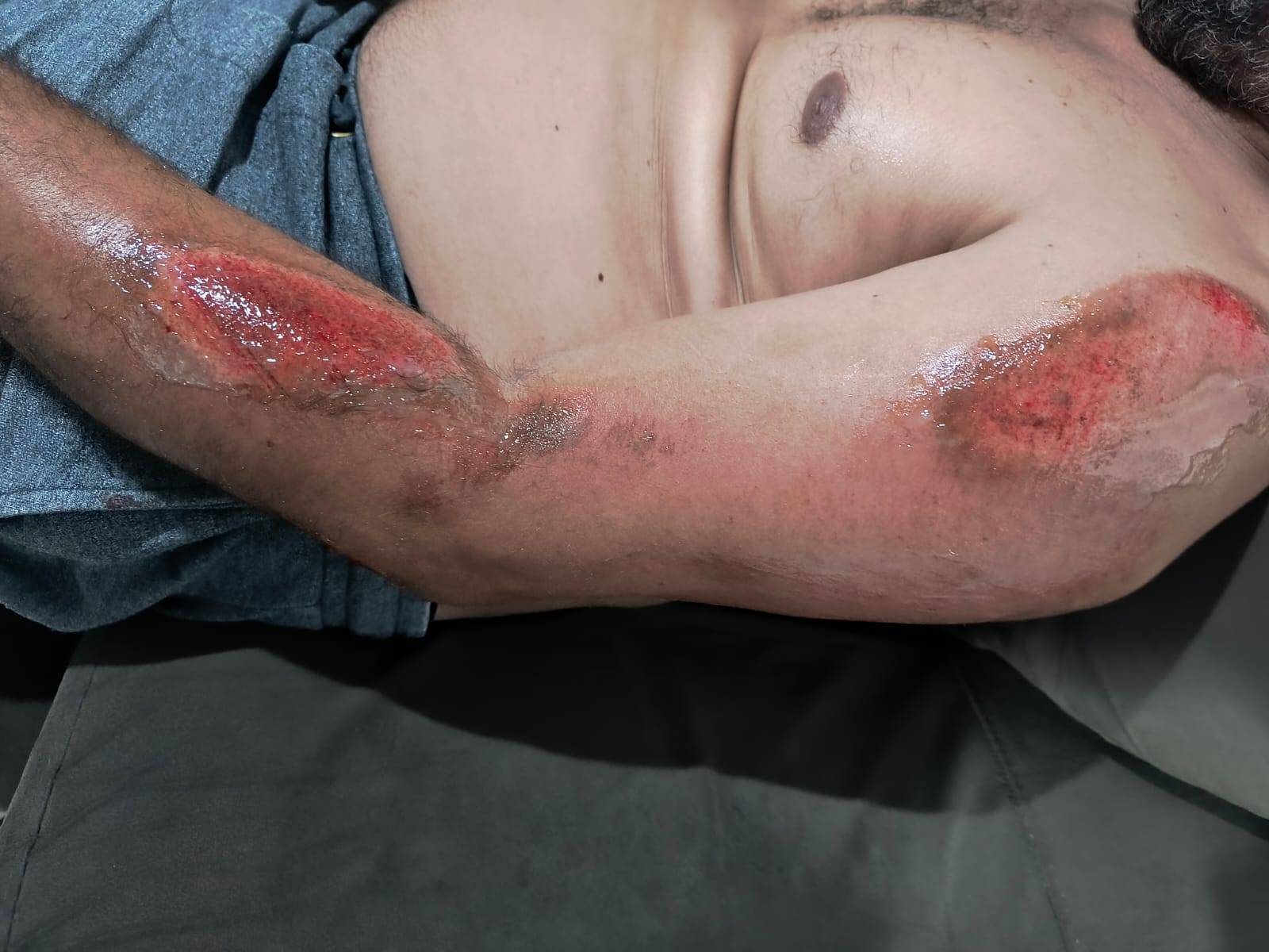 VEJA FOTOS: autônomo fica todo ralado após cair em quebra-molas sem sinalização instalado em avenida de Vilhena