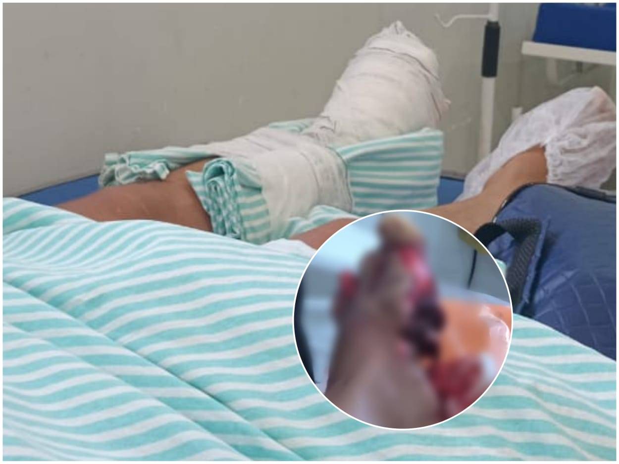 Mulher tem pé lacerado após carro atingir motocicleta em cruzamento no centro de Vilhena; PM e bombeiros mobilizados