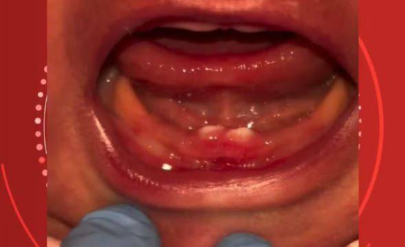 Caso raro: bebê nasce com dentes e precisa de cirurgia nos primeiros dias de vida em cidade de Rondônia