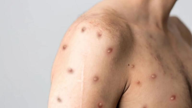 Após casos de Mpox “pipocarem” em Rondônia, autoridades de saúde adotam estratégias contra o vírus em Mato Grosso