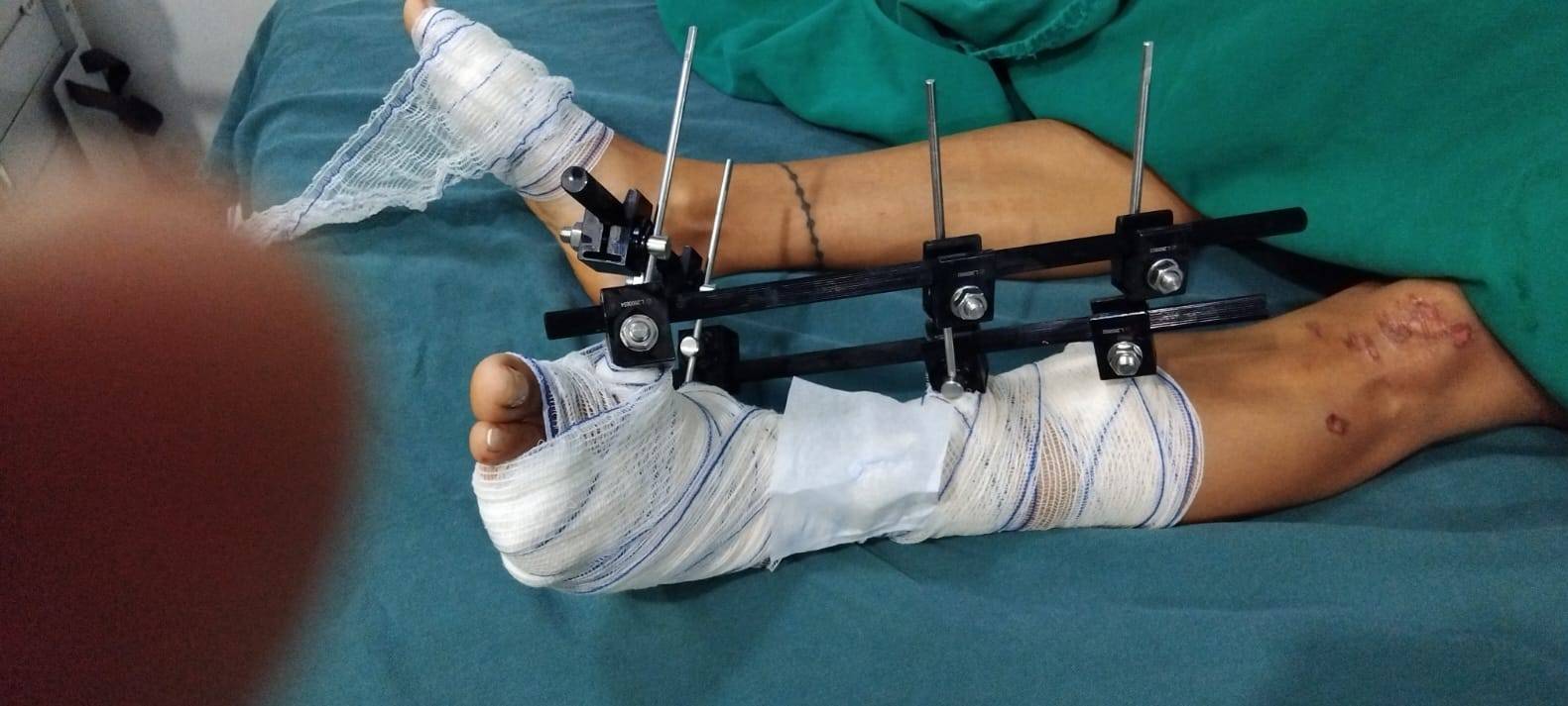 Venezuelana e filhinho autista de 4 anos sofrem fraturas após acidente de moto, em Vilhena; causador da colisão fugiu do local