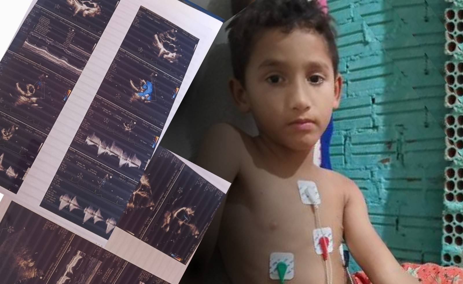 Vilhenense cria campanha e pede doações para tratamento de problemas no coração do filho de 8 anos com TEA e TDAH