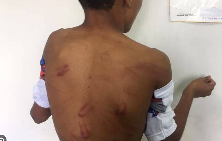 Adolescente com deficiência nos pés denuncia a própria mãe por acoitá-lo com fios de energia e caso vai parar na polícia, em Vilhena