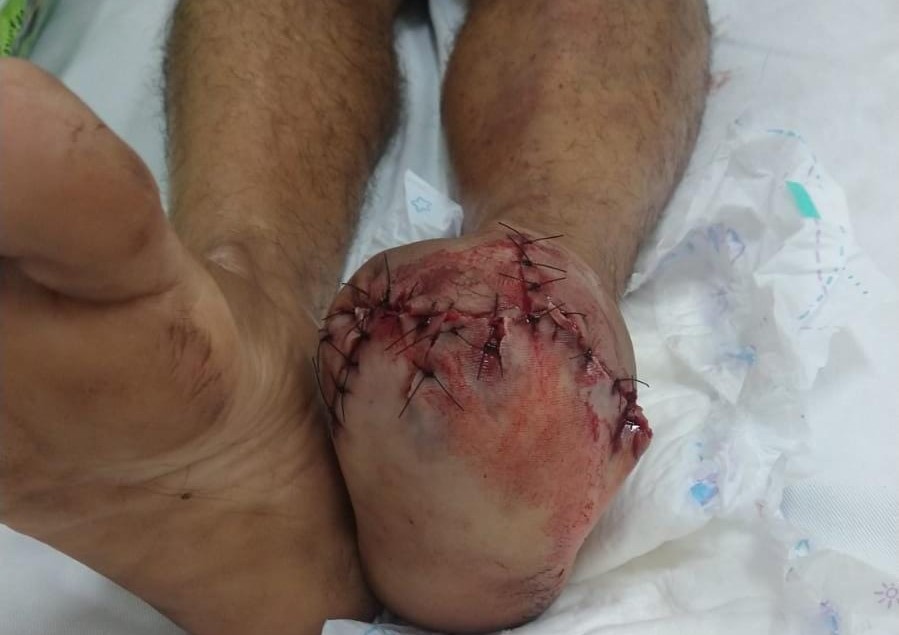 VÍDEO CHOCOU RONDÔNIA: ao tentar apagar “bombinha” com o pé, homem tem membro “arrancado” após explosão