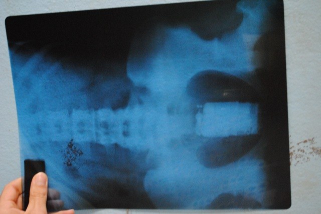 Raio-X mostra celular na vagina de mulher que tentava entrar em presídio