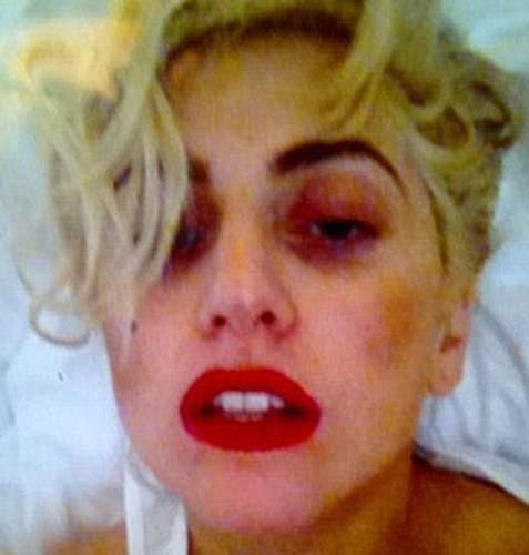 Depois de pancada na cabeça, Lady Gaga publica foto com olho inchado